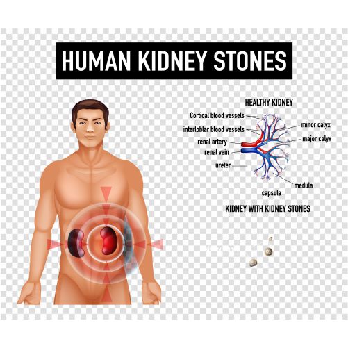 diagram showing human kidney stones transparent background 1 تصویر