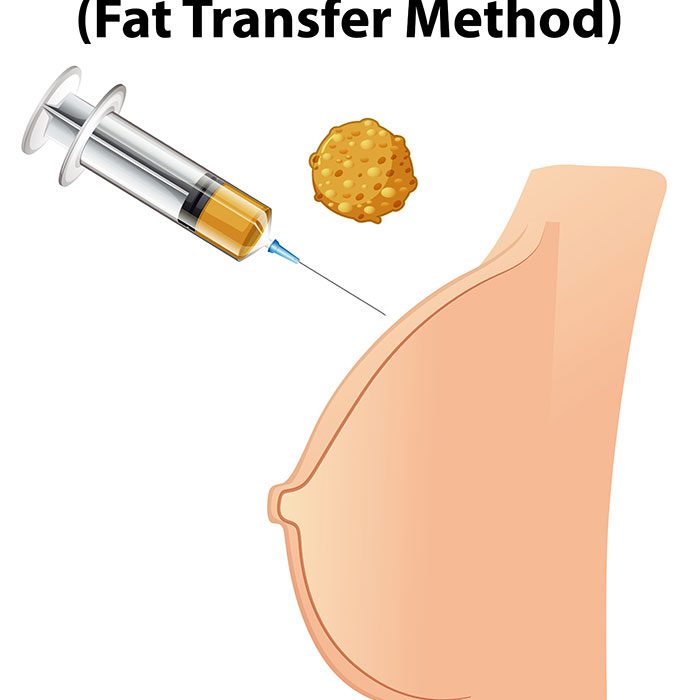 human anatomy breast augmentation 1 وکتور - ایمپلنت - سینه - زن