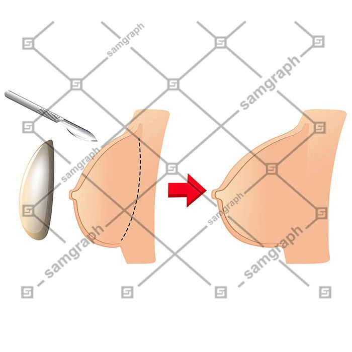 set breast augmentation 1 وکتور - ایمپلنت - سینه - زن