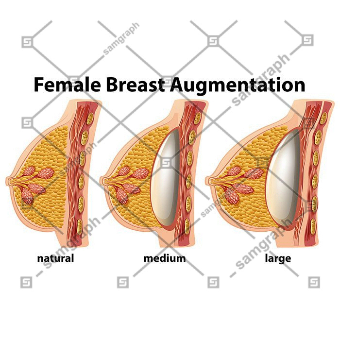 set female breast augmentation 1 وکتور - ایمپلنت - سینه - زن