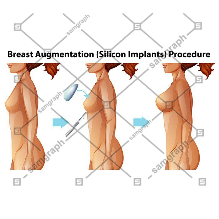 vector female breast implants 1 وکتور - ایمپلنت - سینه - زن